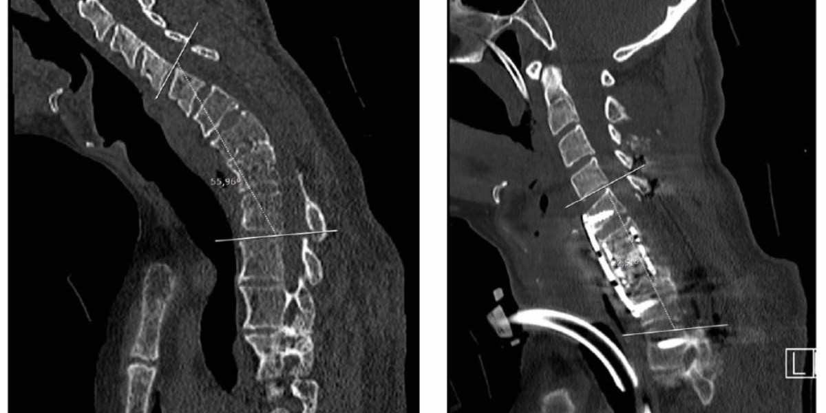 El coll del pacient. Cedida